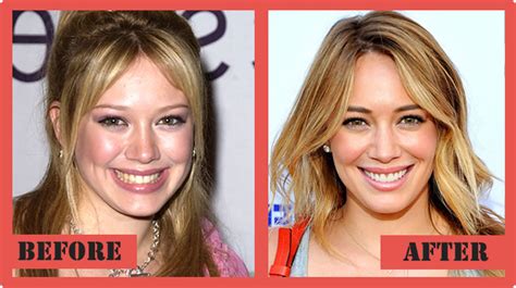 hillary duff plastic surgery|Hilary Duff Plastic Surgery Before and After 